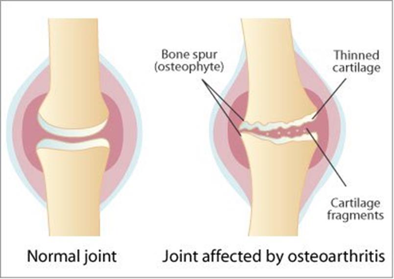 Joint affected by osteoarthritis